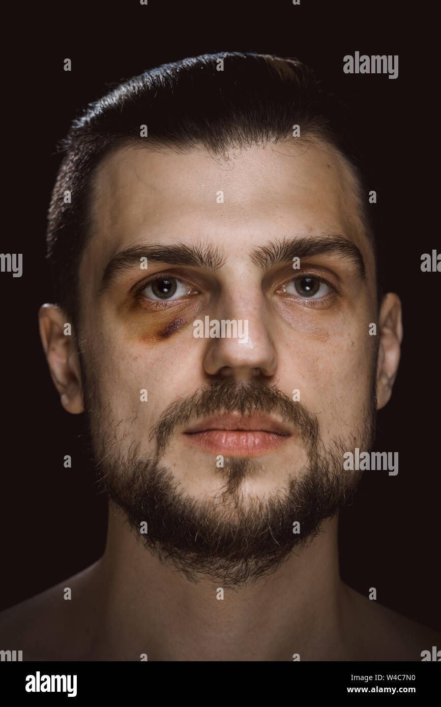 Portrait of a man with bruised skin and black eye. Violence fight eye hematoma shiner. Stock Photo