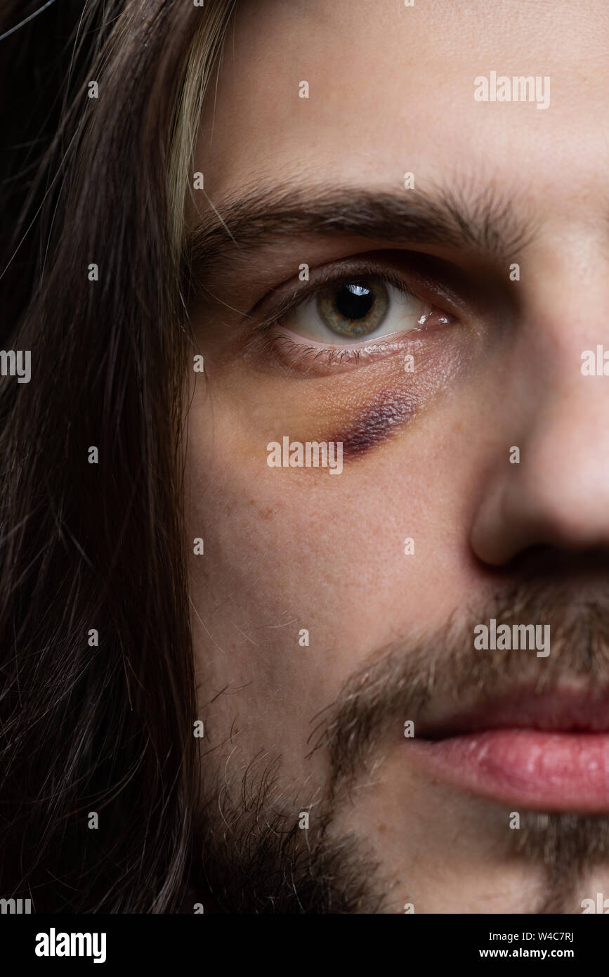 Young man portrait with bruise black eye shiner hematoma. Domestic assault violence concept. Stock Photo