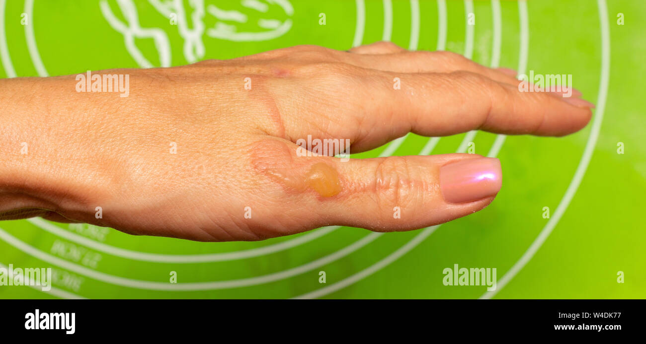 burns blisters from boiling oil on the woman hand closeup Stock Photo
