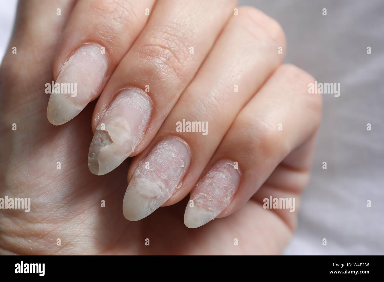 Damage of the nail after using shellac. Stock Photo