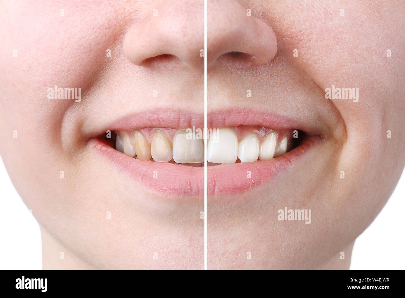 whitening or bleaching treatment ,before and after ,woman teeth and smile, close up, isolated on white background. Stock Photo