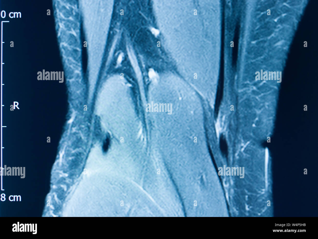 Knee Sports Injury Mri Mcl Grade 2 Tear Magnetic Resonance - 