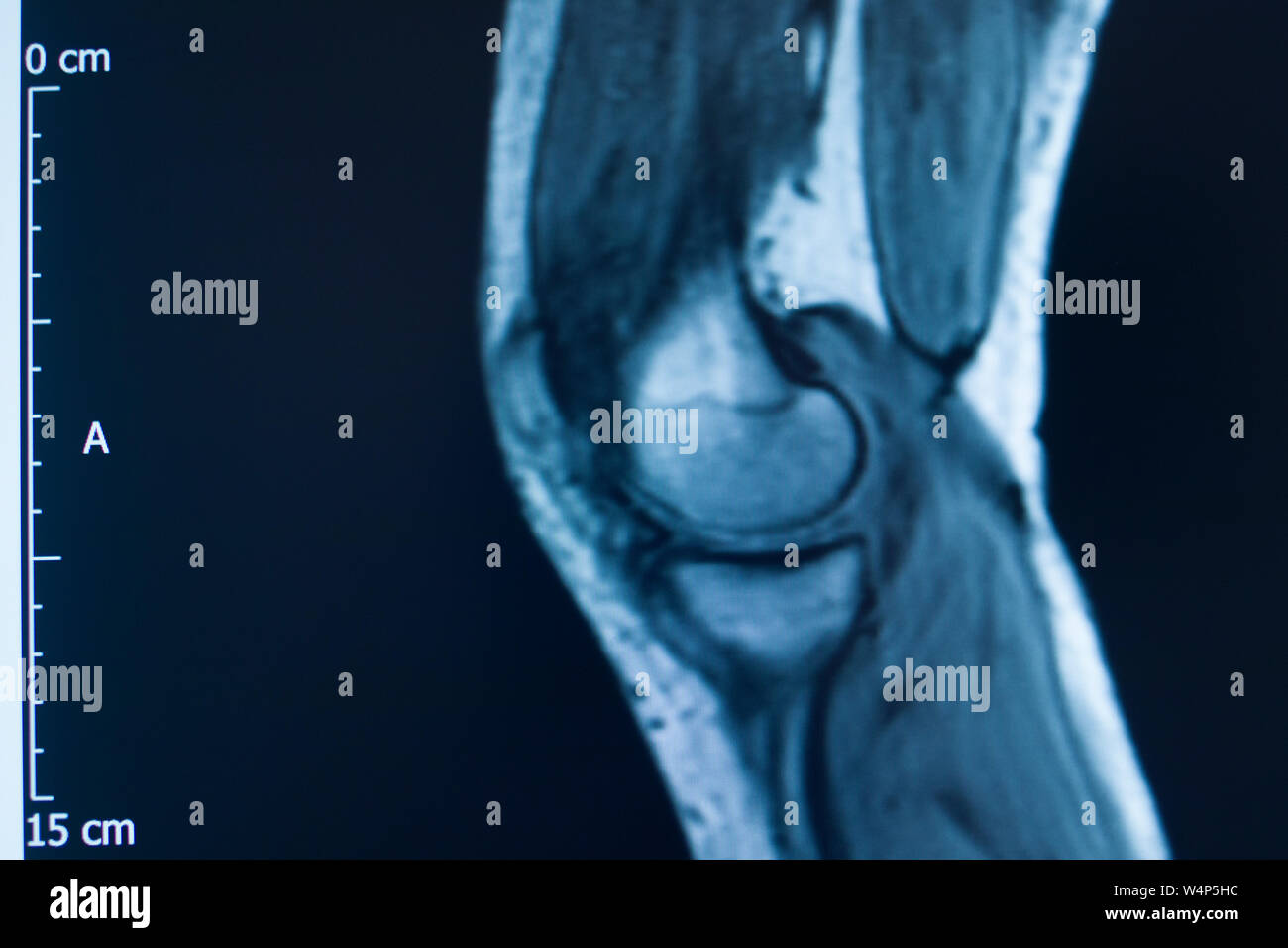 Knee sports injury mri mcl grade 2 tear resonance imaging
