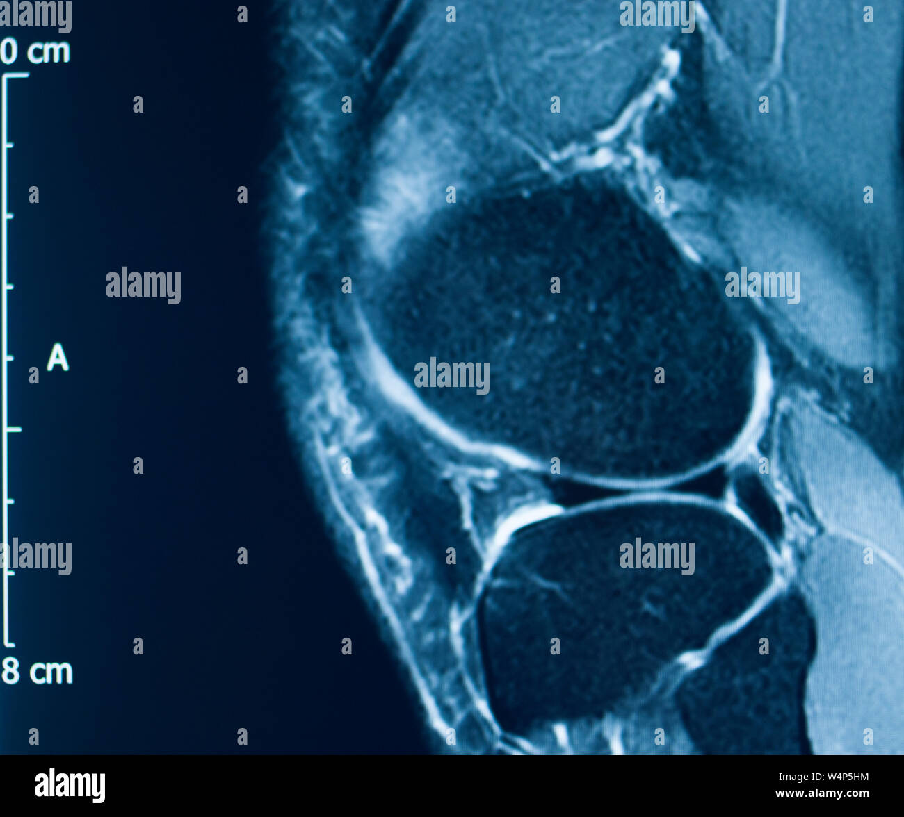 Knee sports injury mri mcl grade 2 tear resonance imaging