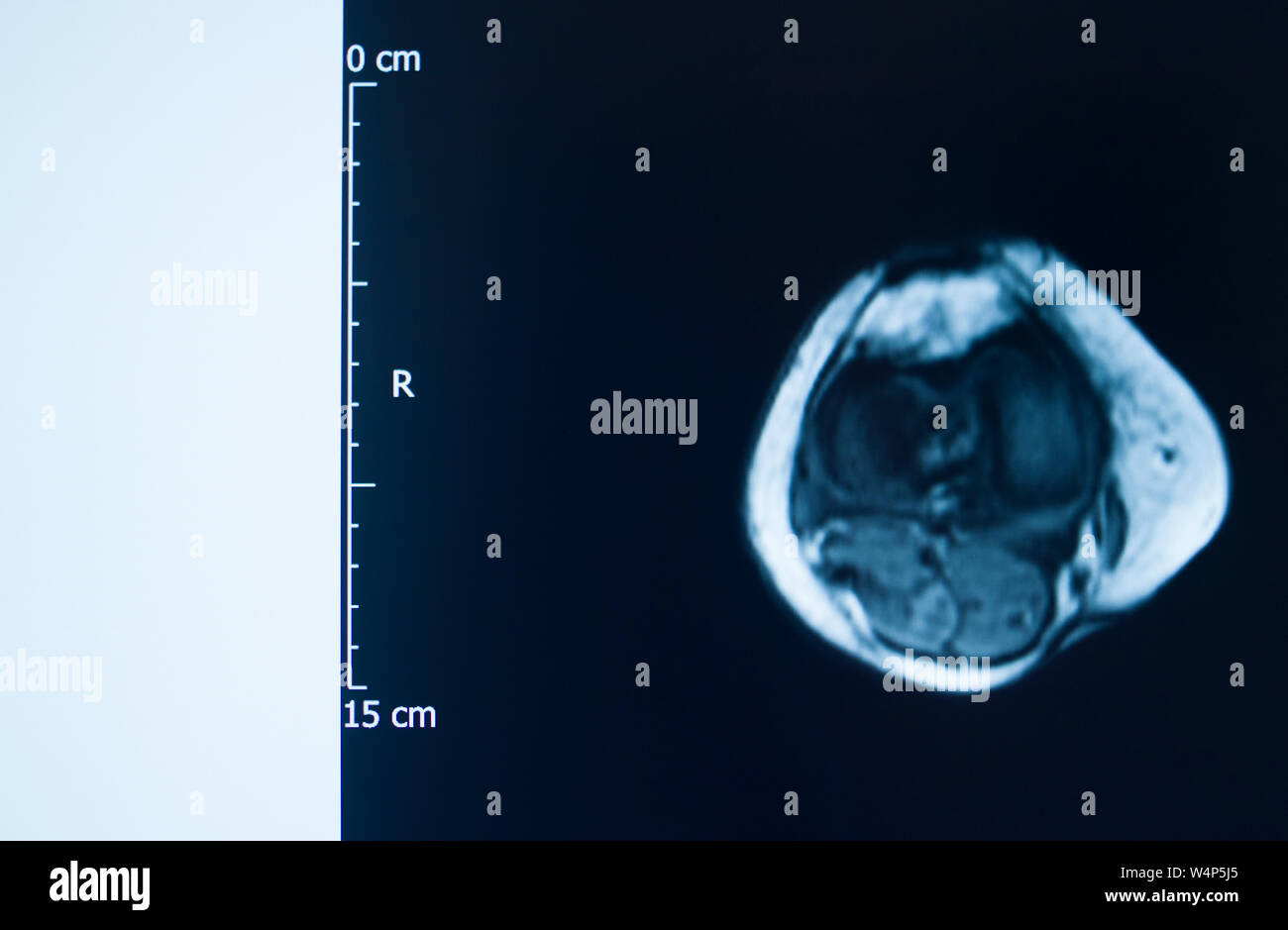 Knee sports injury mri mcl grade 2 tear resonance imaging