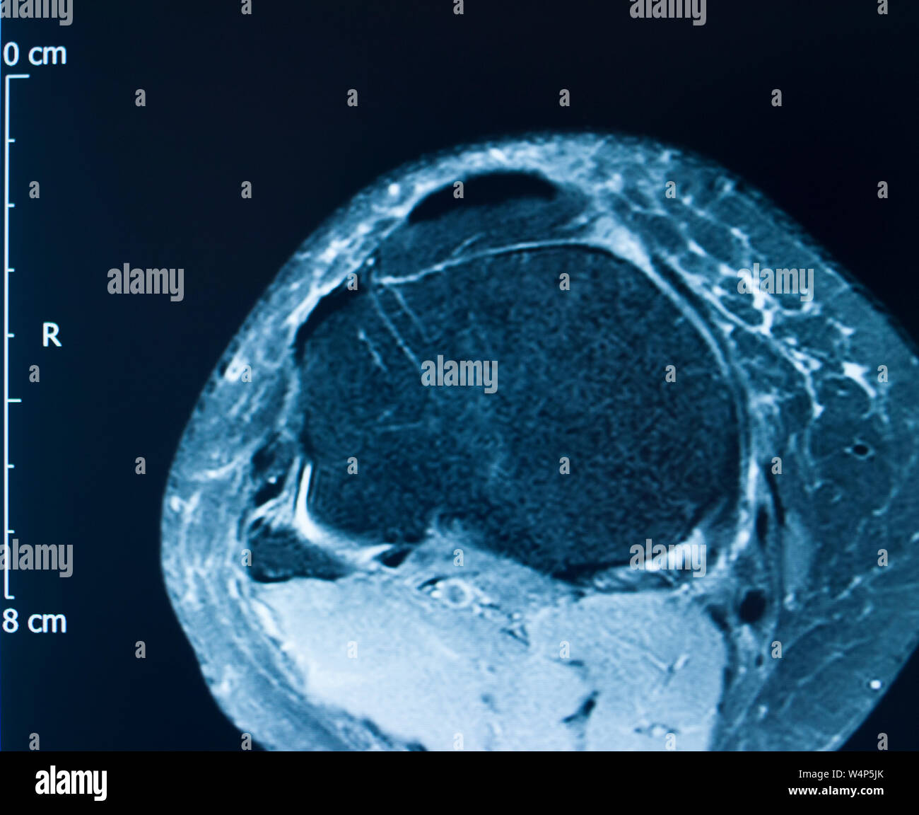 Knee sports injury mri mcl grade 2 tear resonance imaging