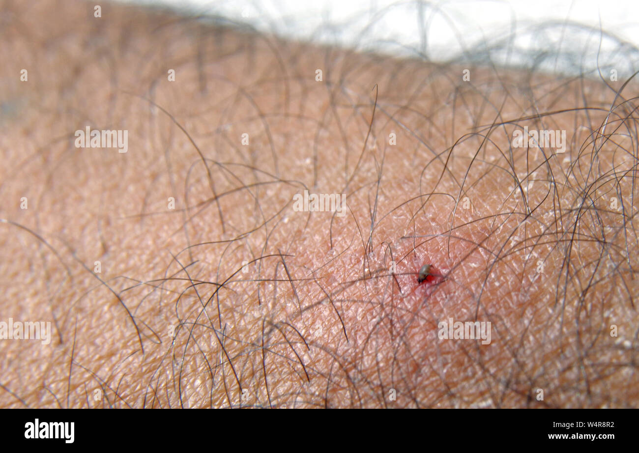 Lyme disease is a bacterial infection spread to humans by infected ticks Stock Photo