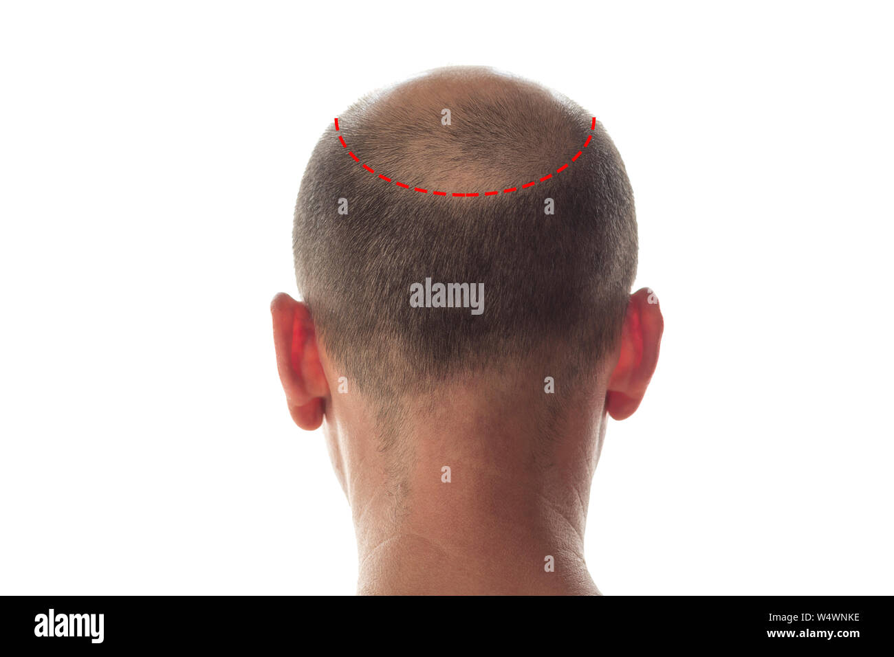 Bald man back view, head with hair loss Stock Photo