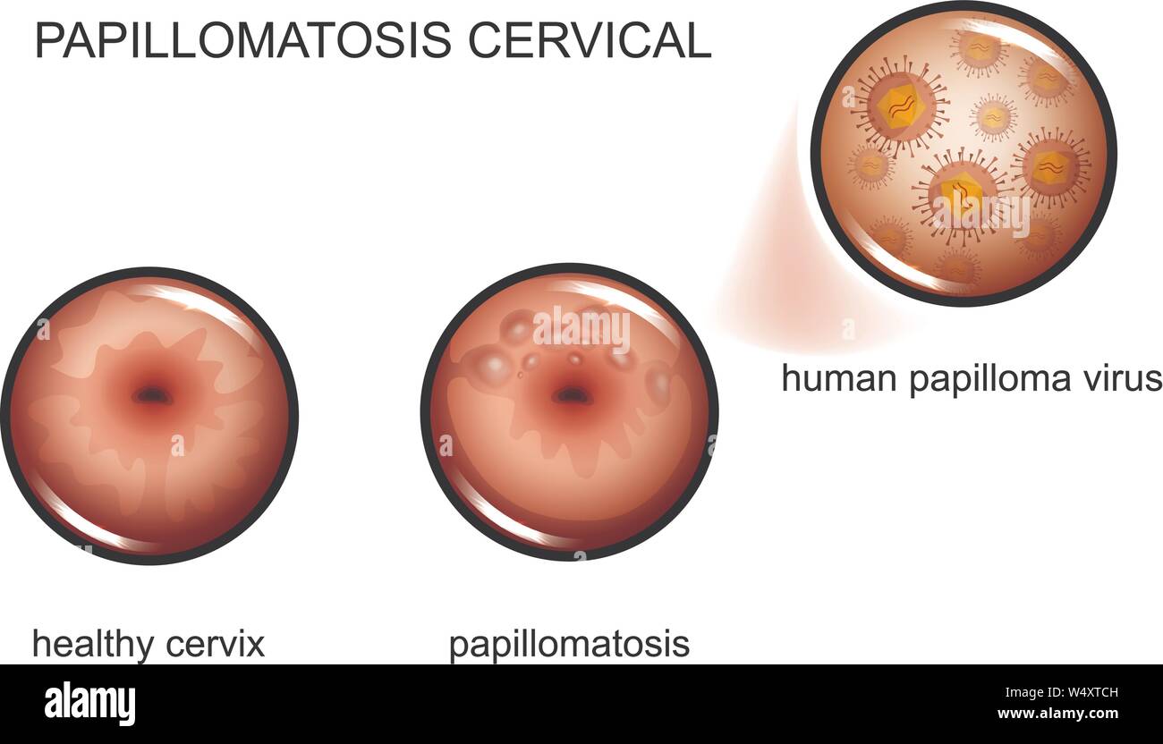vector illustration of cervical papillomatosis. human papilloma virus Stock Vector