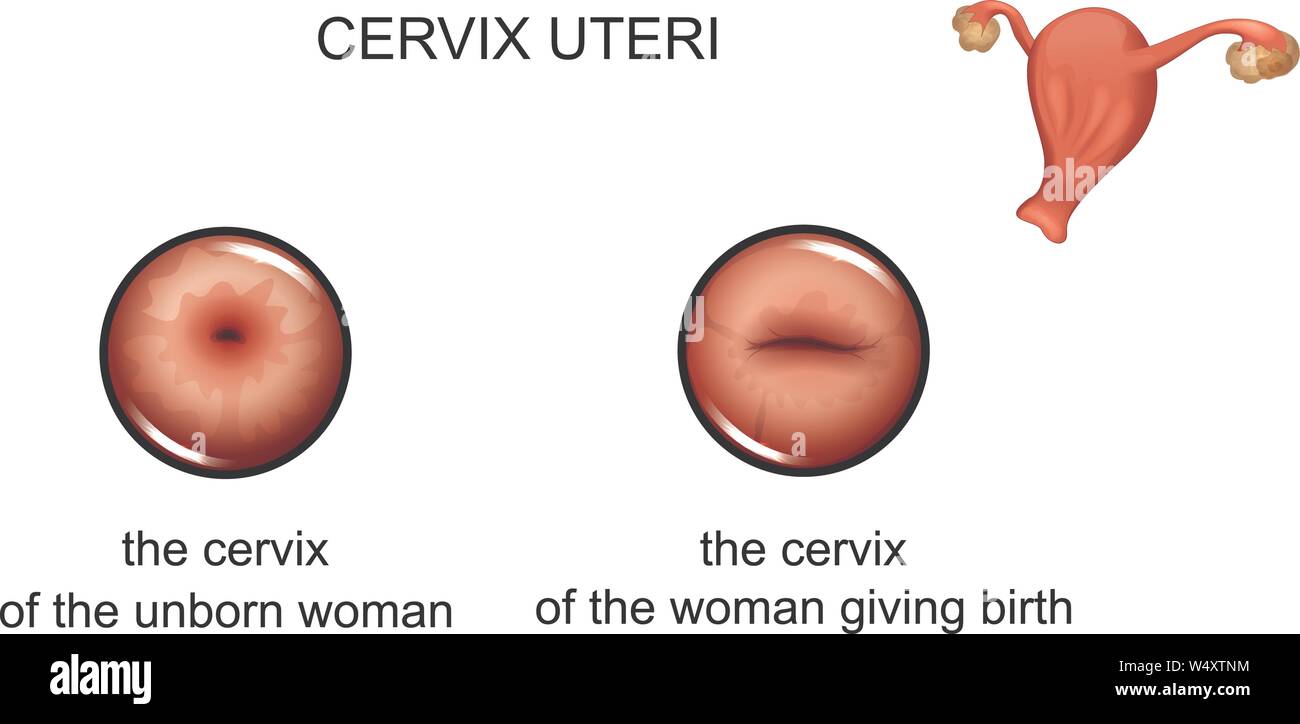 vector illustration of giving birth and not giving birth to the cervix Stock Vector