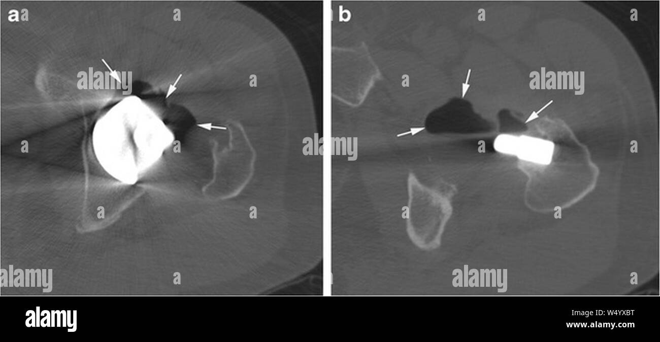 CT of hip prosthesis with pneumarthrosis Stock Photo - Alamy