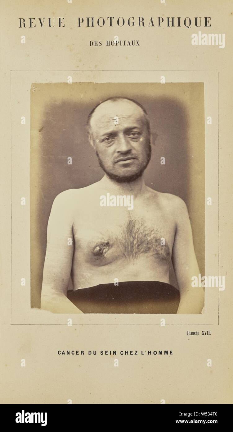 Cancer du sein chez l'homme, A. de Montmeja (French, active 1870s), Paris, France, 1871, Albumen silver print, 12.4 × 9.4 cm (4 7/8 × 3 11/16 in Stock Photo