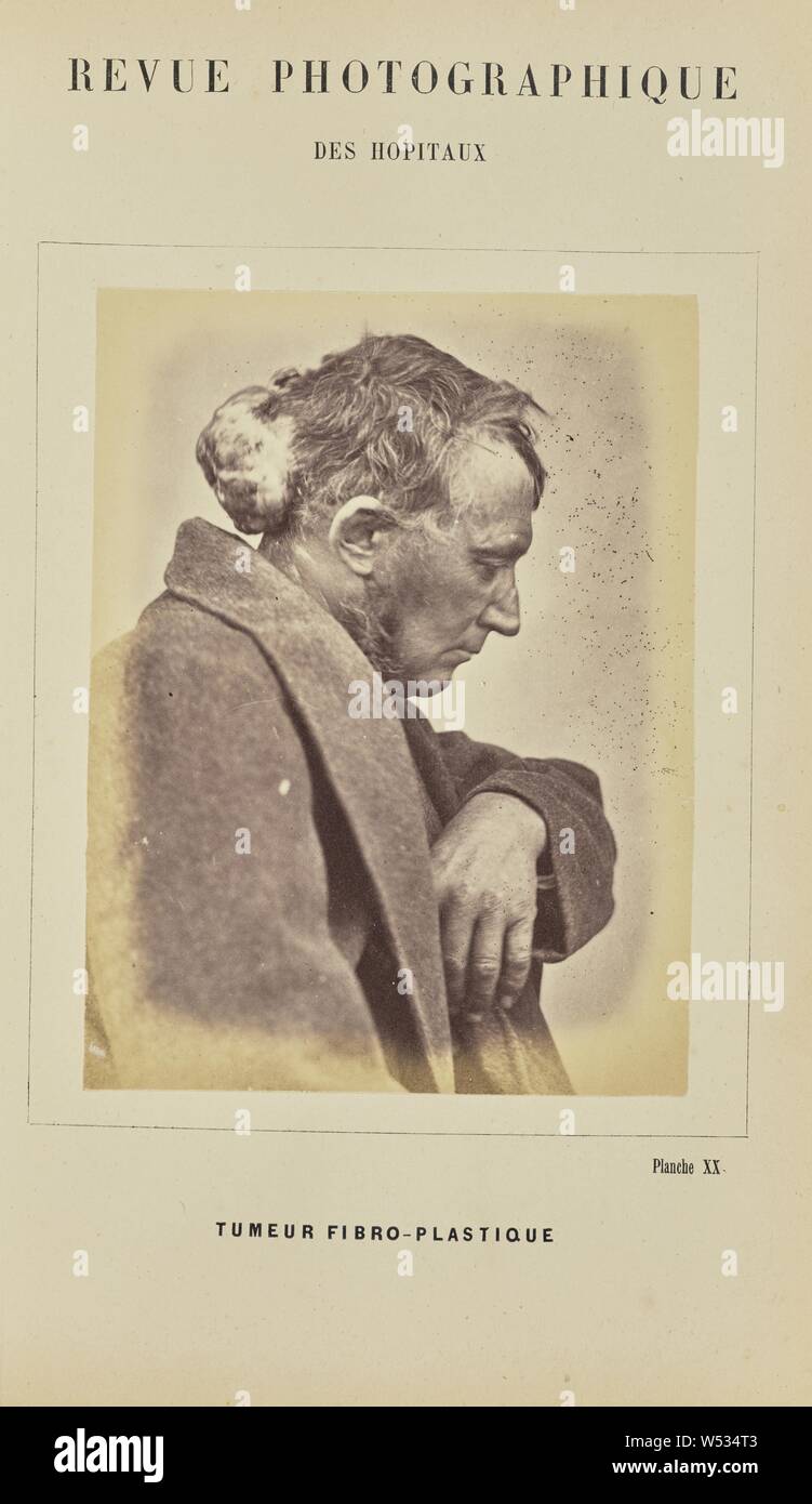 Tumeur fibro-plastique, A. de Montmeja (French, active 1870s), Paris, France, 1871, Albumen silver print, 12.3 × 9.4 cm (4 13/16 × 3 11/16 in Stock Photo