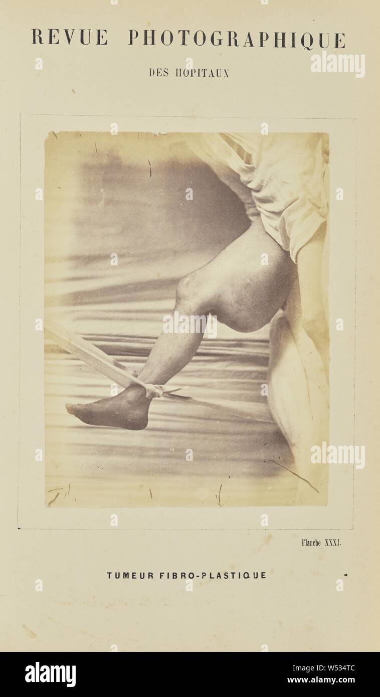 Tumeur fibro-plastique, A. de Montmeja (French, active 1870s), Paris, France, 1871, Albumen silver print, 12.4 × 9.4 cm (4 7/8 × 3 11/16 in Stock Photo