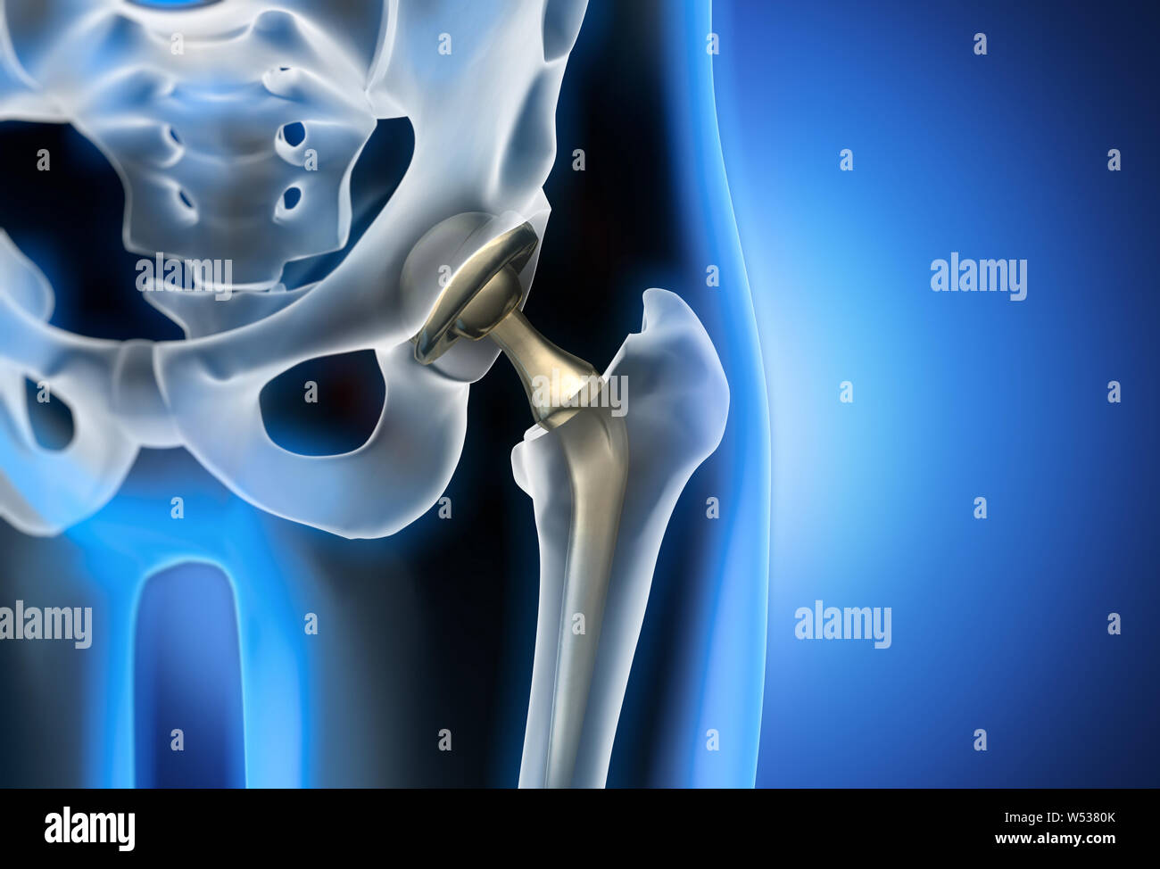 Artificial hip joint closeup - 3D illustration Stock Photo