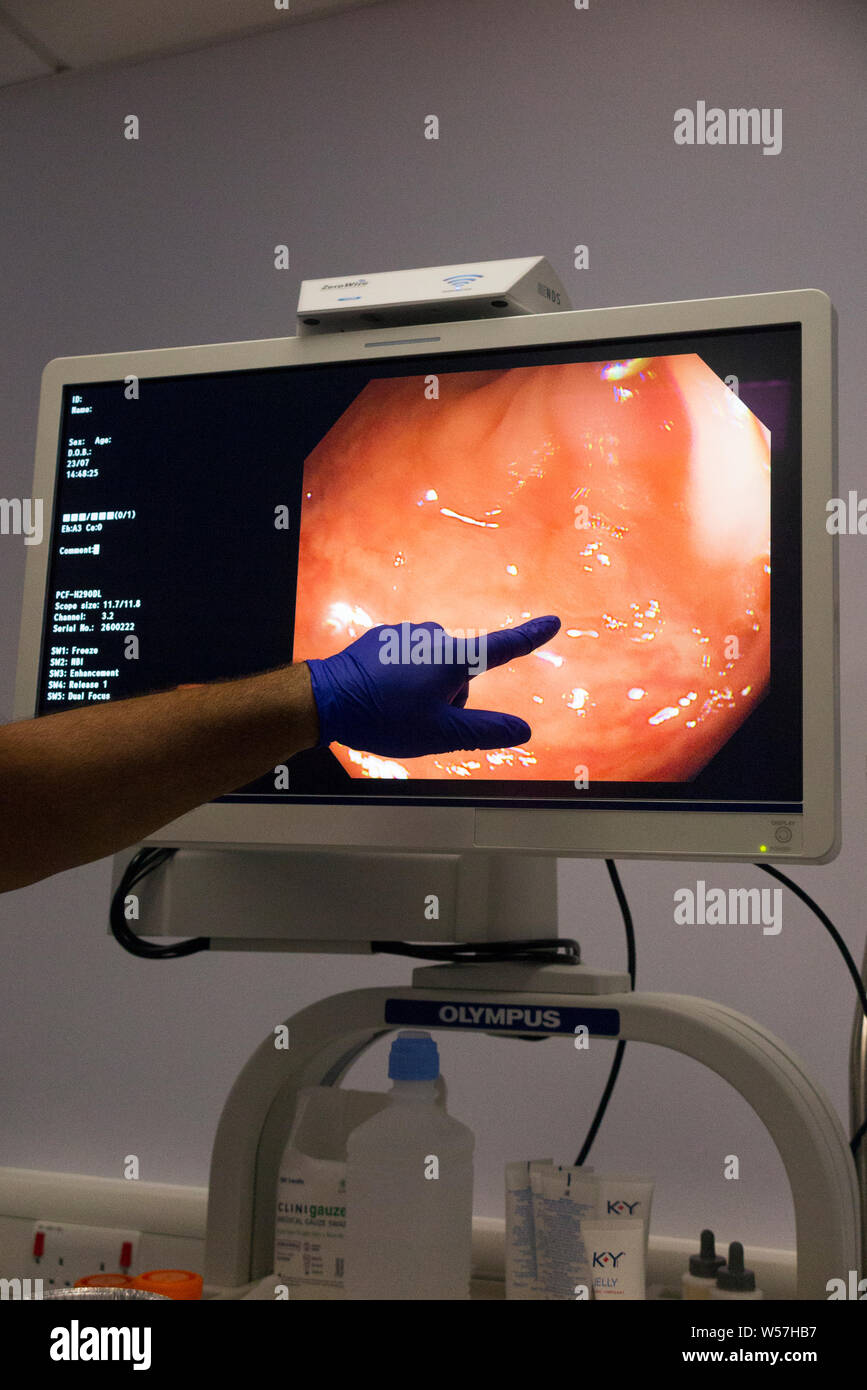 Finger pointing at a small precancerous polyp: display screen during the bowel scope screening test (flexible sigmoidoscopy bowel cancer screening) for people aged 55 to 60 years old. The endoscope image is used to look for pre-cancerous polyps in the (sigmoid colon) large bowel colon and rectum. (111) Stock Photo