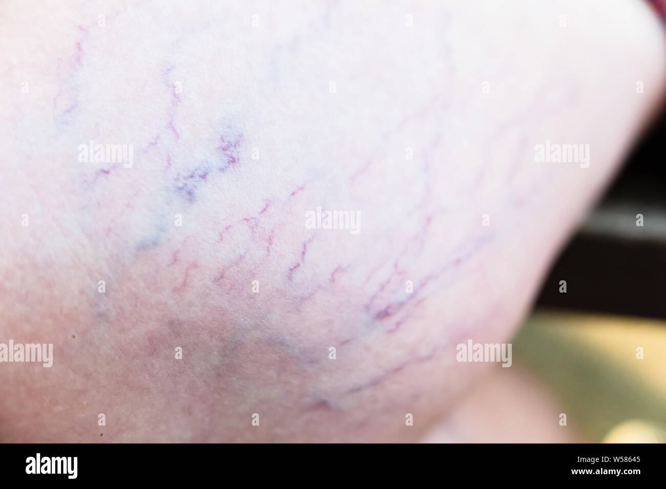 Detail of varicose veins on the leg of a seated woman Stock Photo Alamy