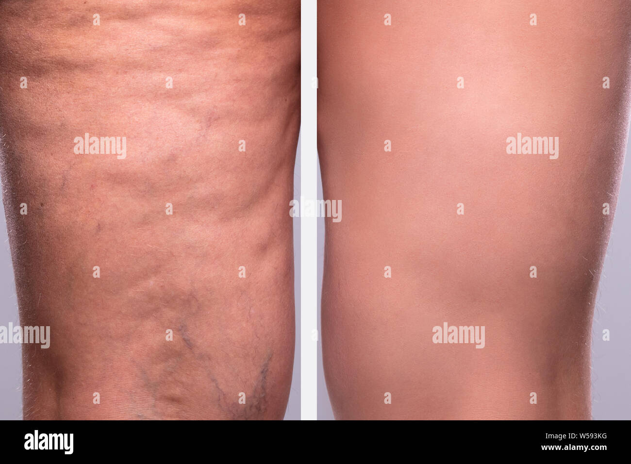 Comparison Of A Person's Legs Thighs With And Without Cellulite Stock Photo