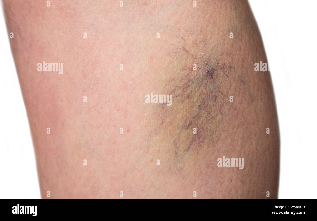Bursted capillaries on a woman leg Stock Photo