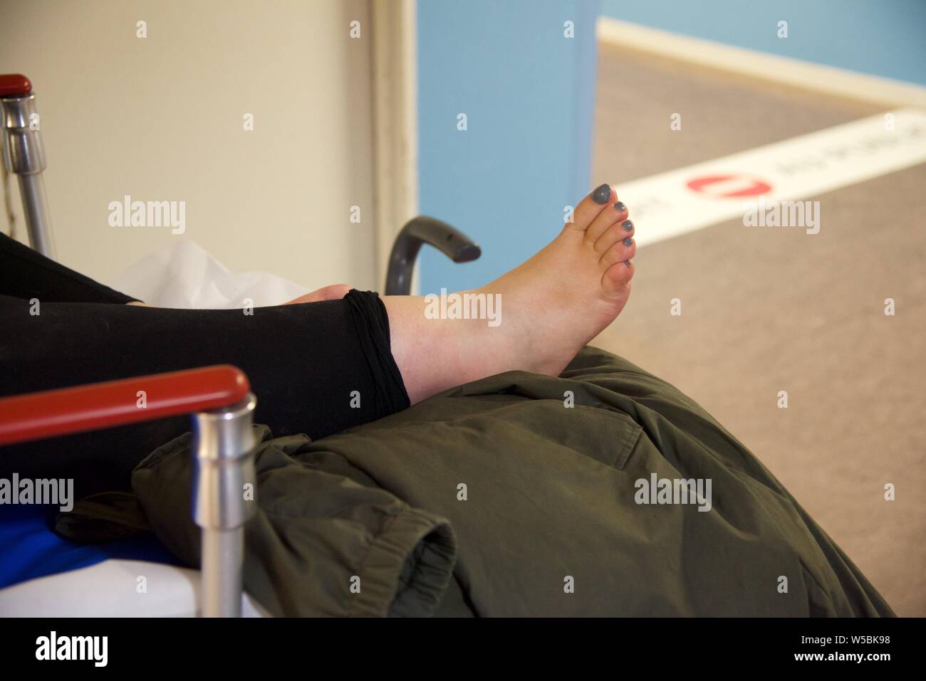 Broken ankle: a female patient with a broken right ankle waits on a gurney in the corridor of an hospital emergency department Stock Photo