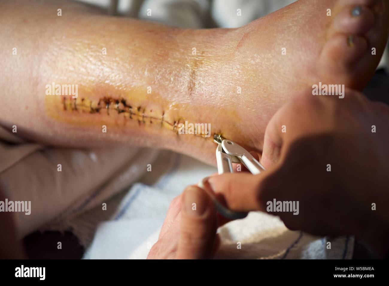 Stitches removed hi-res stock photography and images - Alamy