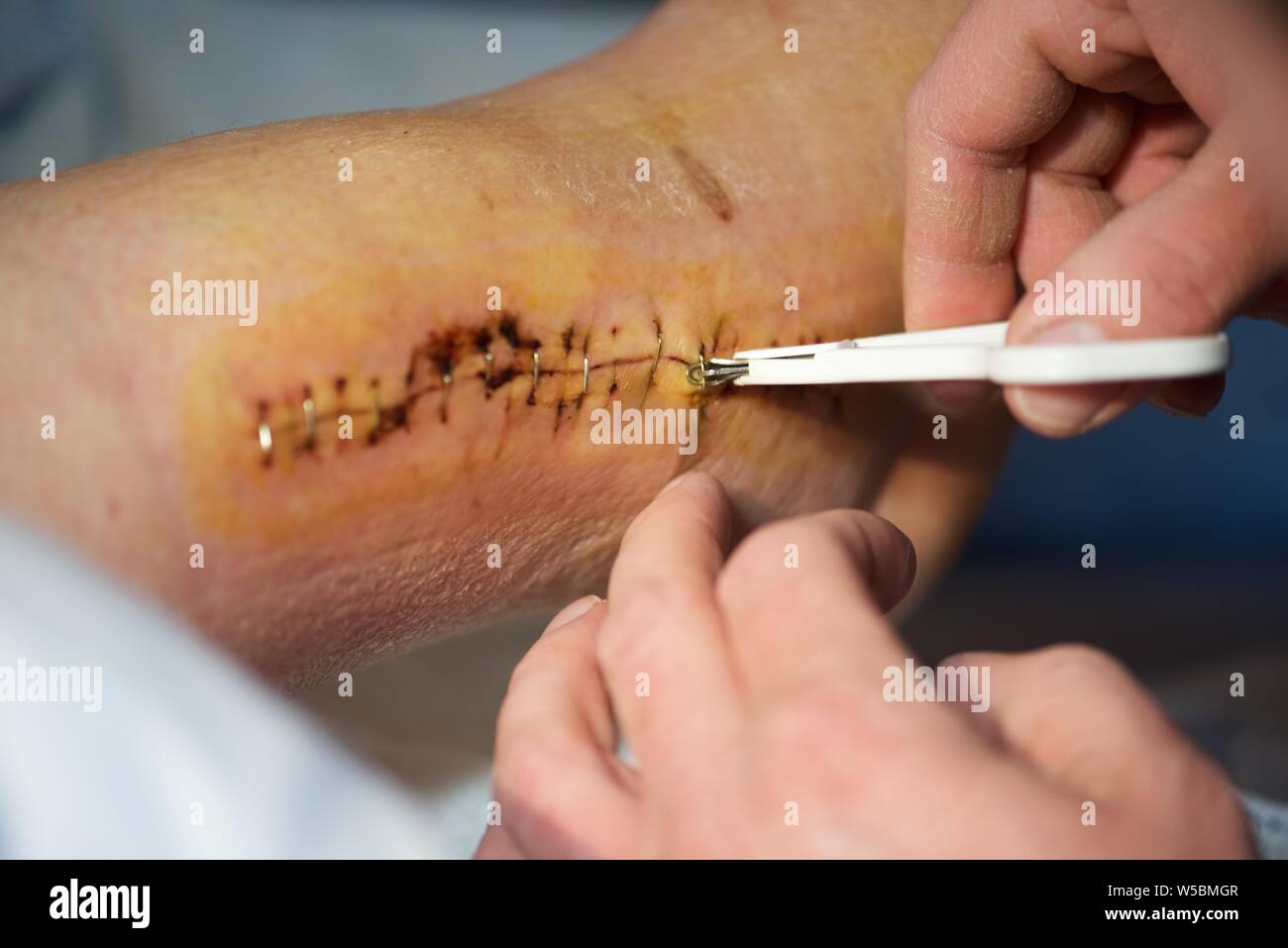 Surgical staples: removal of surgical staples from the right ankle of a female patient following surgical intervention to repair a broken ankle Stock Photo