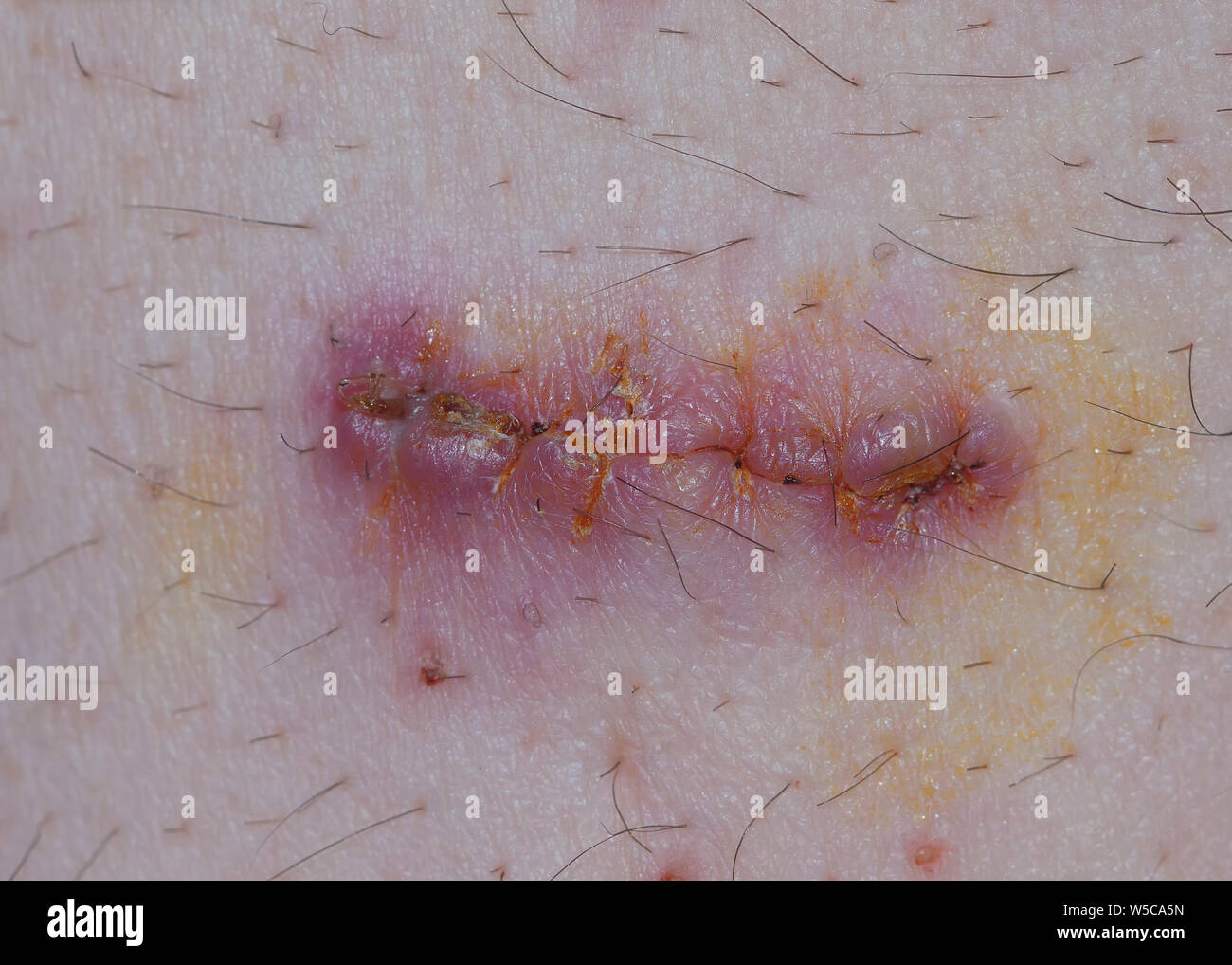 Infected stitched wound (knife cut Stock Photo Alamy