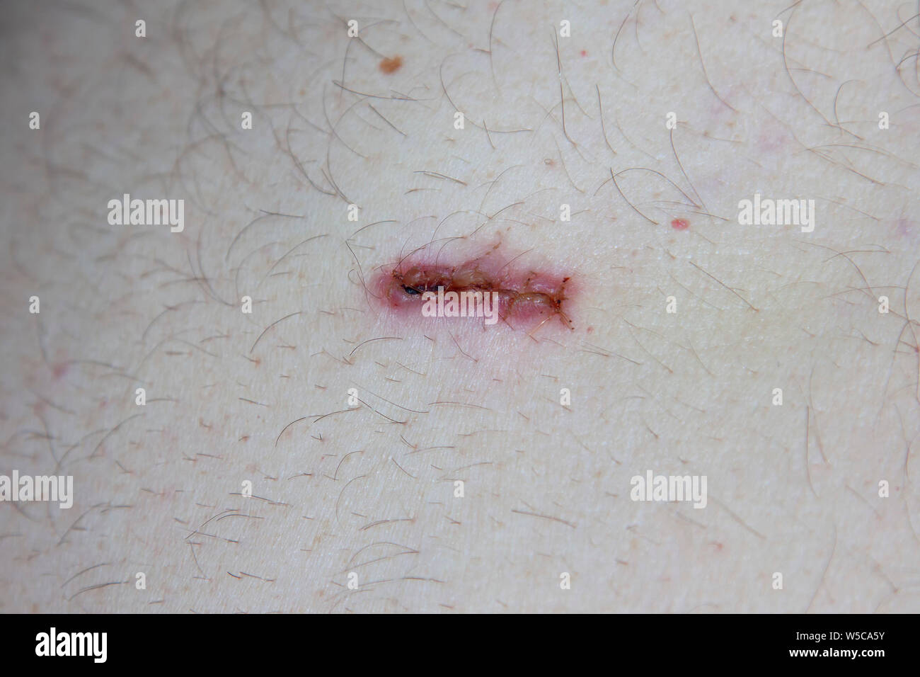 Infected stitched wound (knife cut Stock Photo Alamy