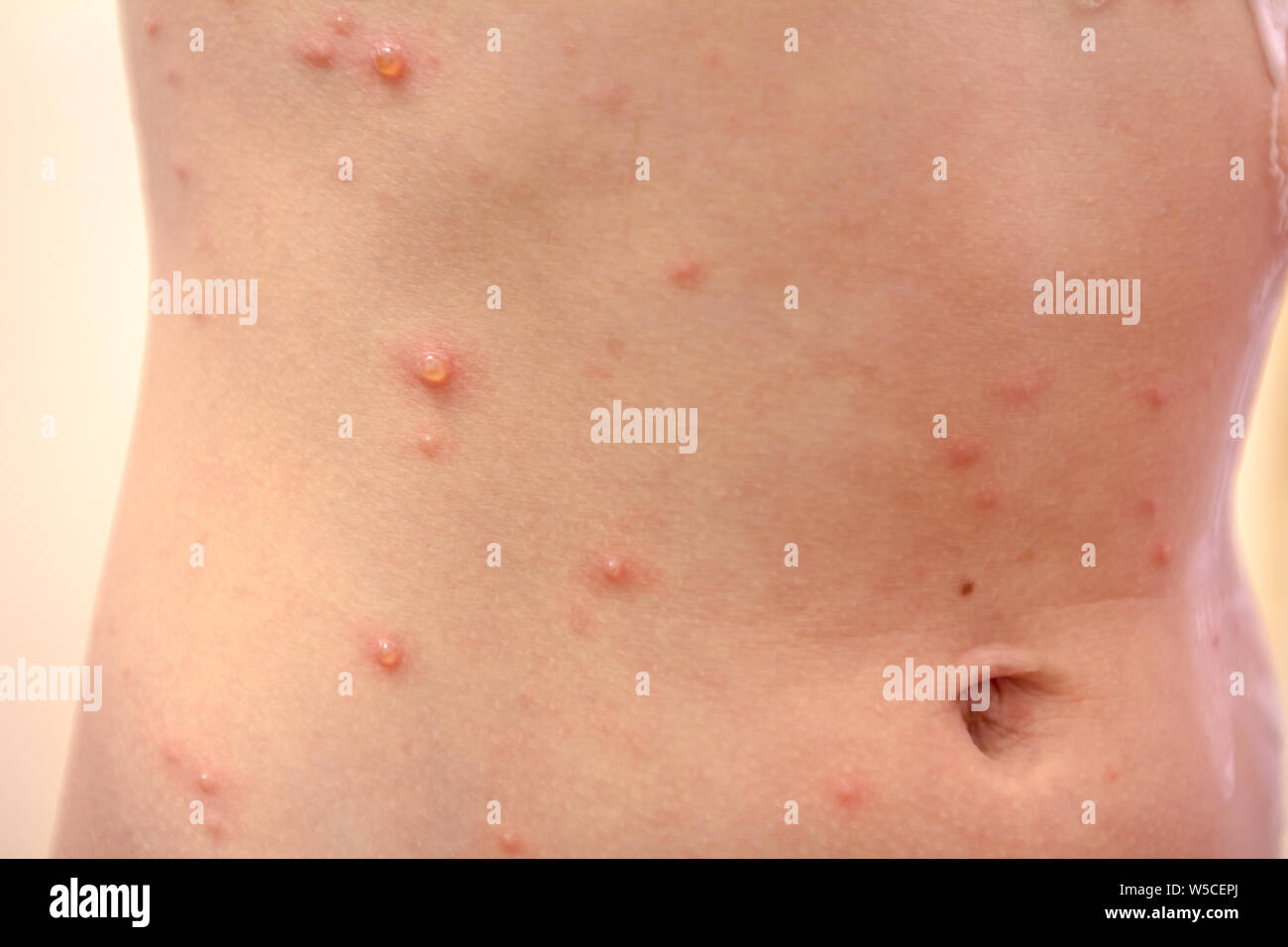 Child With Virus Of Varicella Has Measles Chicken Pox Rubella All Over The Body Viral Diseases Stock Photo Alamy