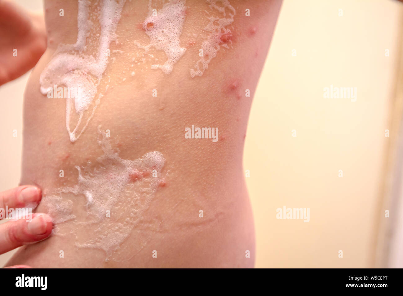 Child skin infected with chickenpox is having treatment using antiseptic foam. Stock Photo