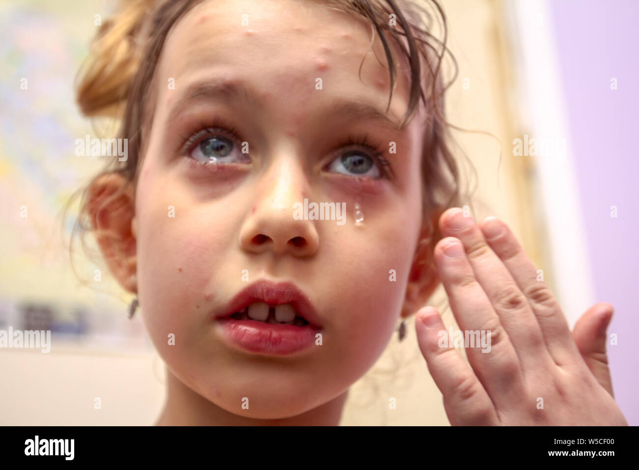 Portrait of sad child girl with virus of varicella has measles, chicken pox, rubella all over the body. Viral Diseases Stock Photo