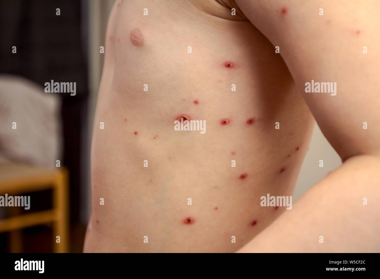 pix Early Stage Measles Smallpox Early Stage Measles Chicken Pox Symptoms https www alamy com child with virus of varicella has measles chicken pox rubella all over the body viral diseases image261504052 html