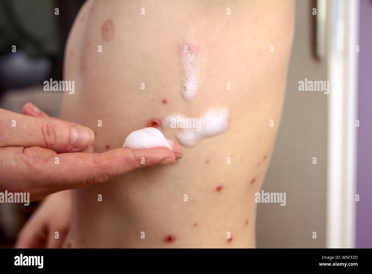 Chickenpox Stock Photos Chickenpox Stock Images Alamy