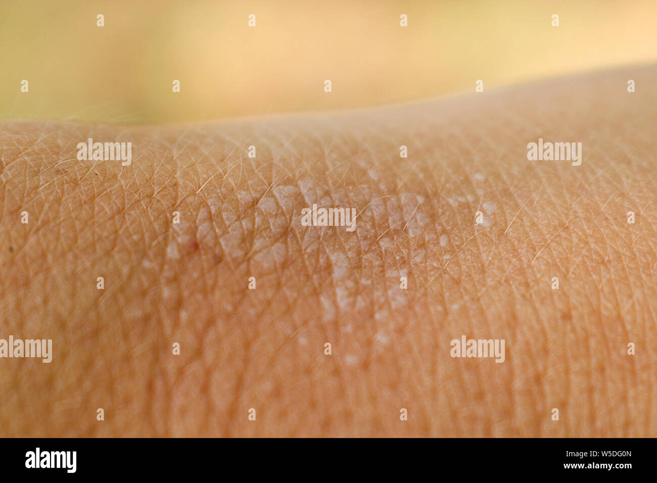 Blisters on human skin on the hand from sunburn close-up. Macro. Stock Photo