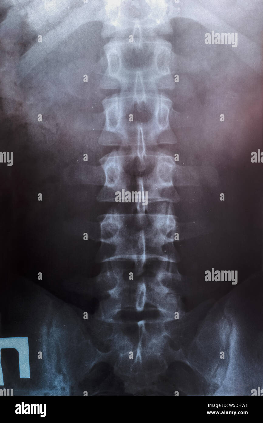 Xray of the lumbar spine, spine on xray Stock Photo Alamy