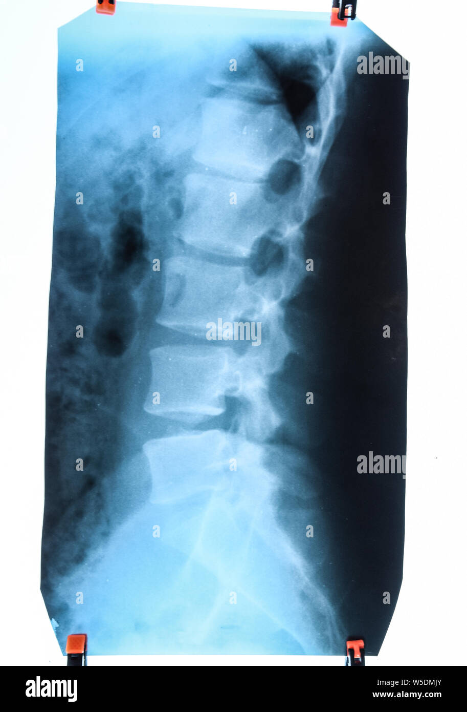 X-ray of the lumbar spine, spine on x-ray Stock Photo - Alamy
