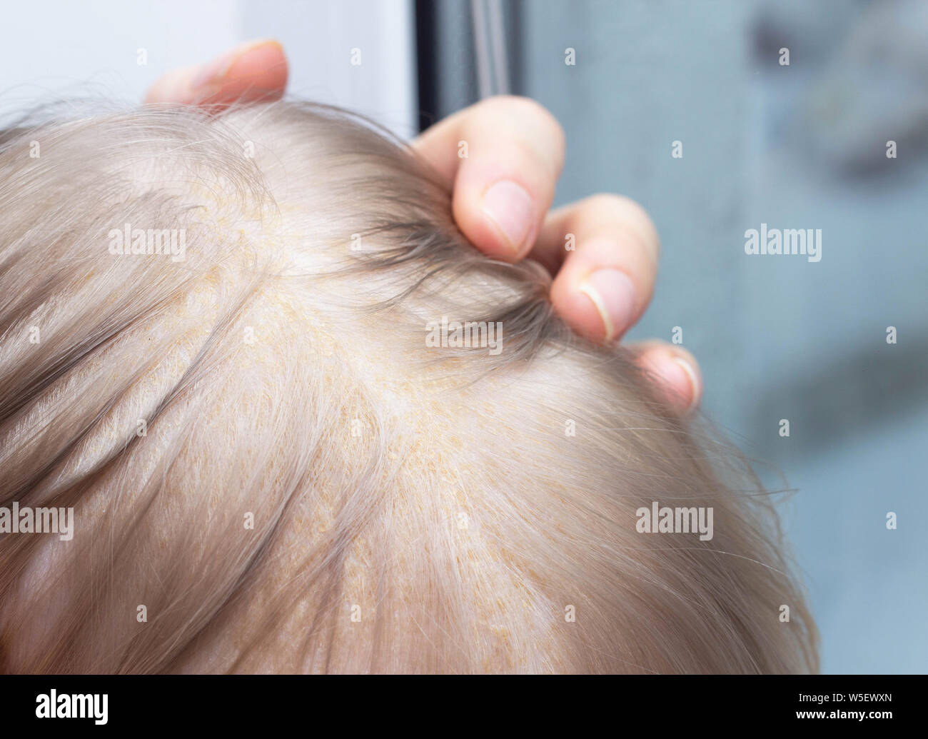 Fungal skin disease seborrheic dermatitis in a child's head, close-up, seborrhea crust Stock Photo