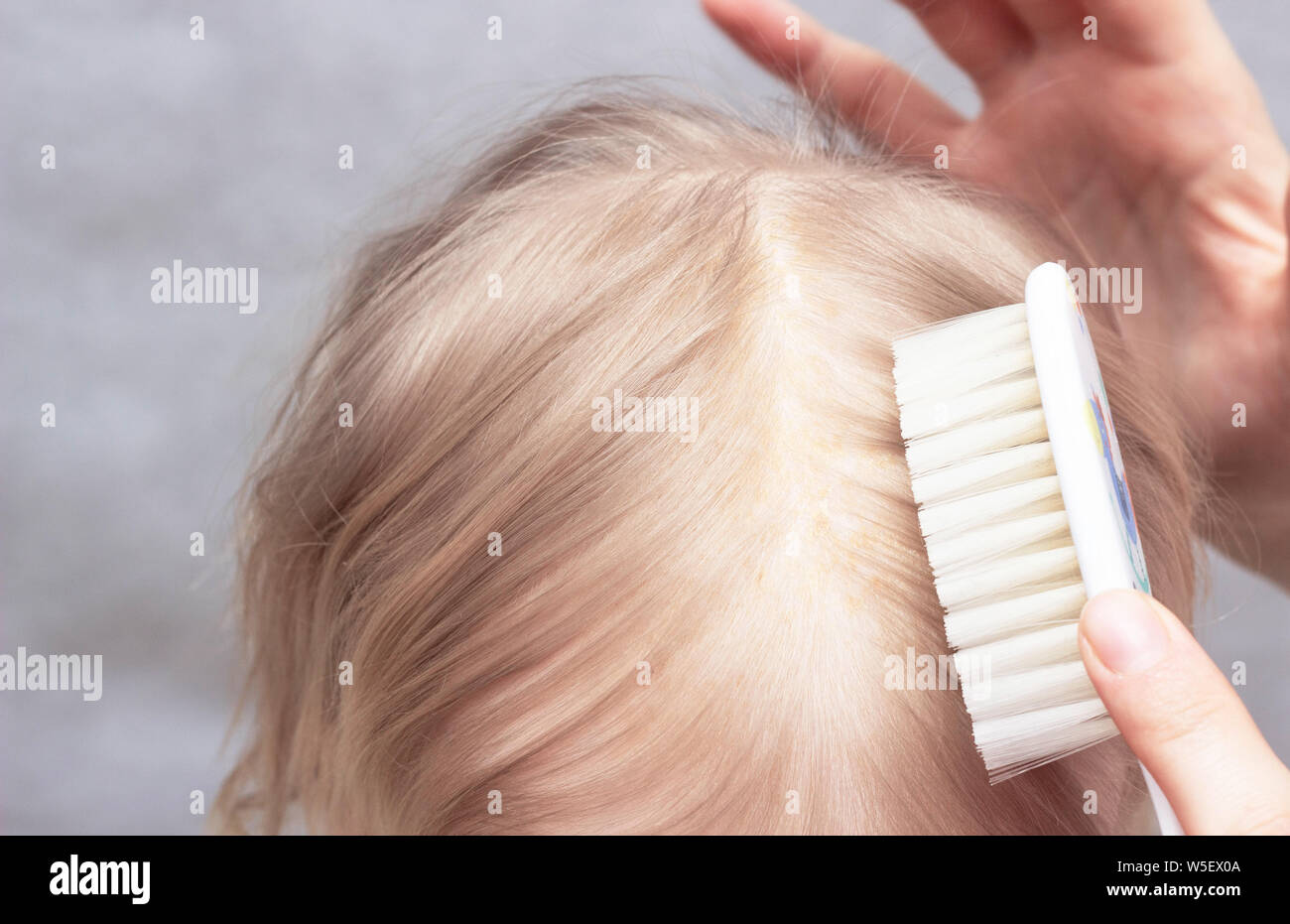 Mother Combing Seborrheic Crust On Baby S Head Close Up Seborrhoeic Dermatitis Inflammatory Dermatology Stock Photo Alamy