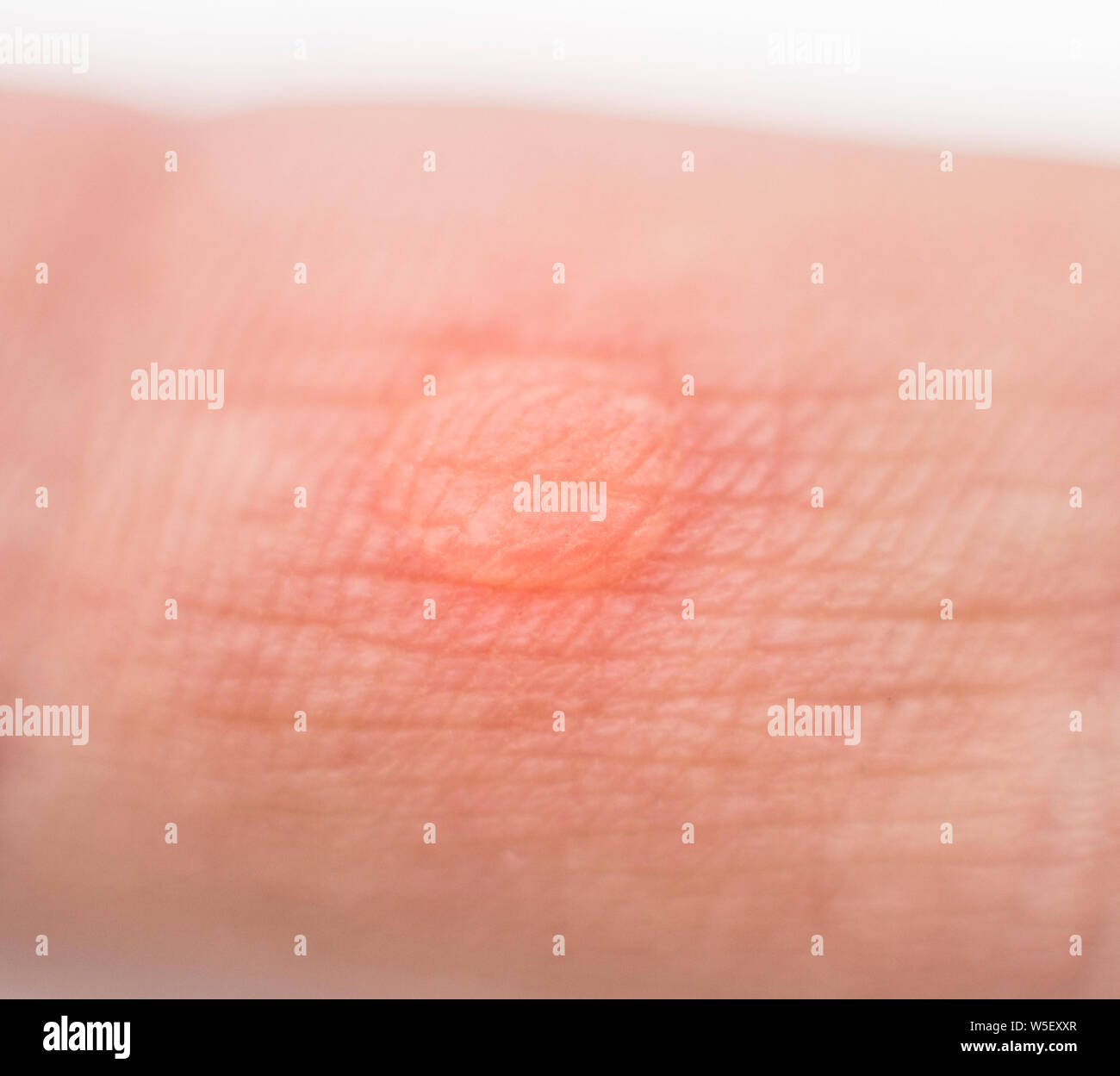 Callus finger hires stock photography and images Alamy