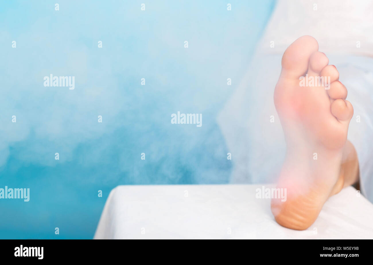 Treatment of warts on the sole of the foot and corns with liquid nitrogen and cryotherapy, plantar wart and corns Stock Photo