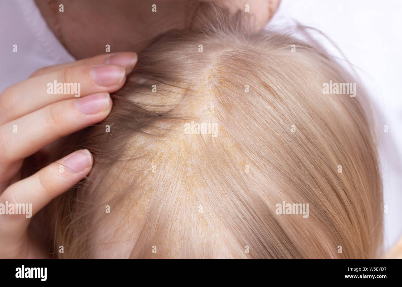 Seborrheic skin rash on the child s head, seborrheic dermatitis, close-up, inflammatory Stock Photo