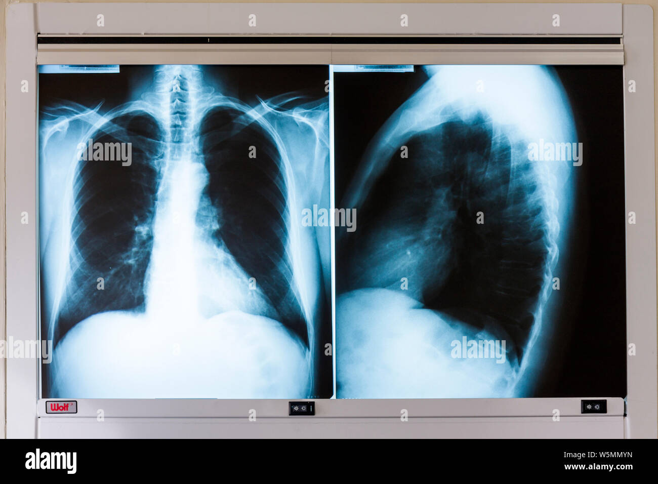 Miami Beach Florida,Mt. Mount Sinai Medical Center,hospital,healthcare,doctor's office,adult male chest x ray,radiography,diagnosis,test,exam,screenin Stock Photo