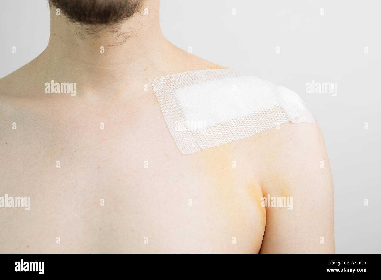white caucasian male with a broken collarbone / clavicle / clavicula after surgery with a band aid after a bike crash Stock Photo