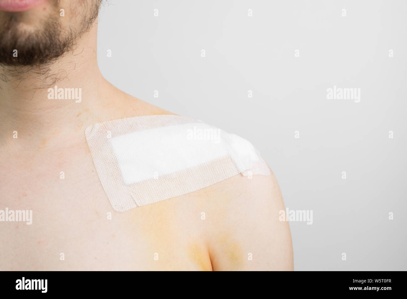 white caucasian male with a broken collarbone / clavicle / clavicula after surgery with a band aid after a bike crash Stock Photo