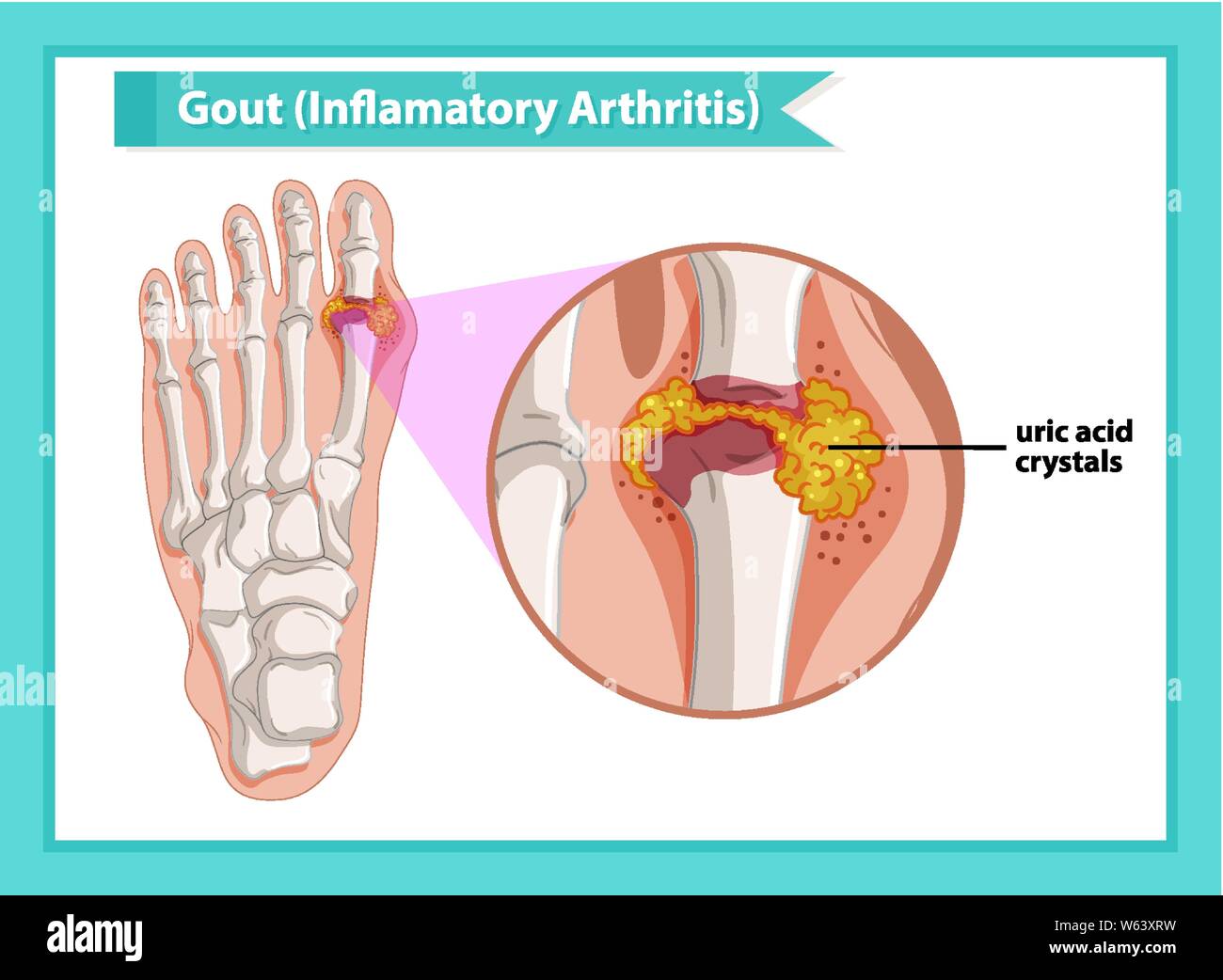 Scientific medical illustration of gout arthritis illustration Stock