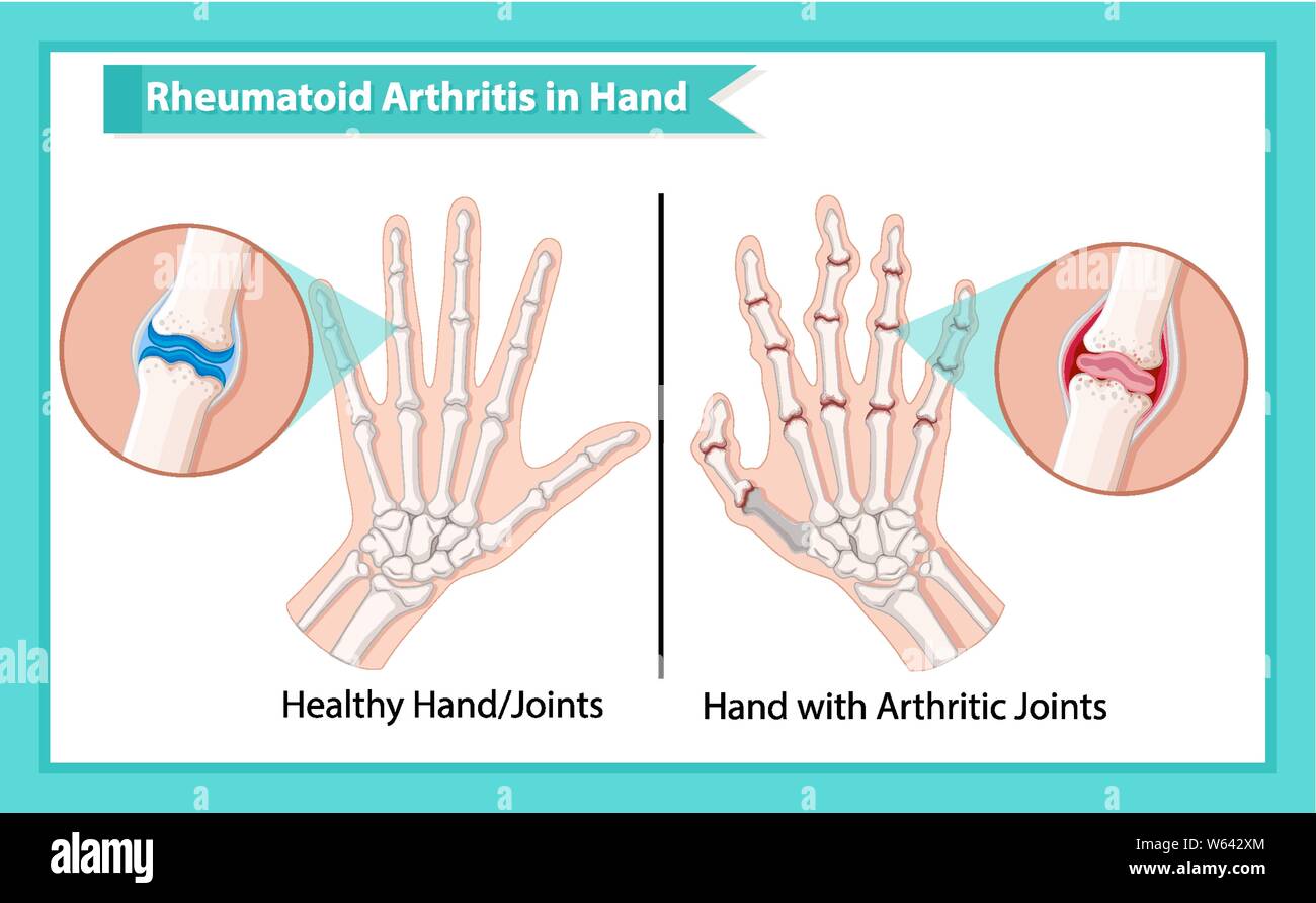 Scientific medical illustration of rheumatoid arthritis illustration ...