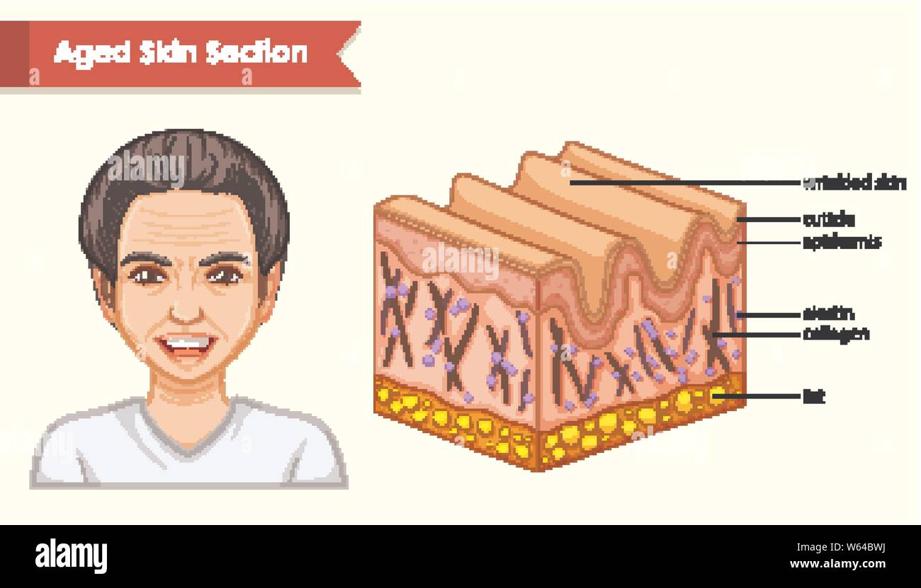 Scientific medical illustration of aged skin with wrinkles illustration ...