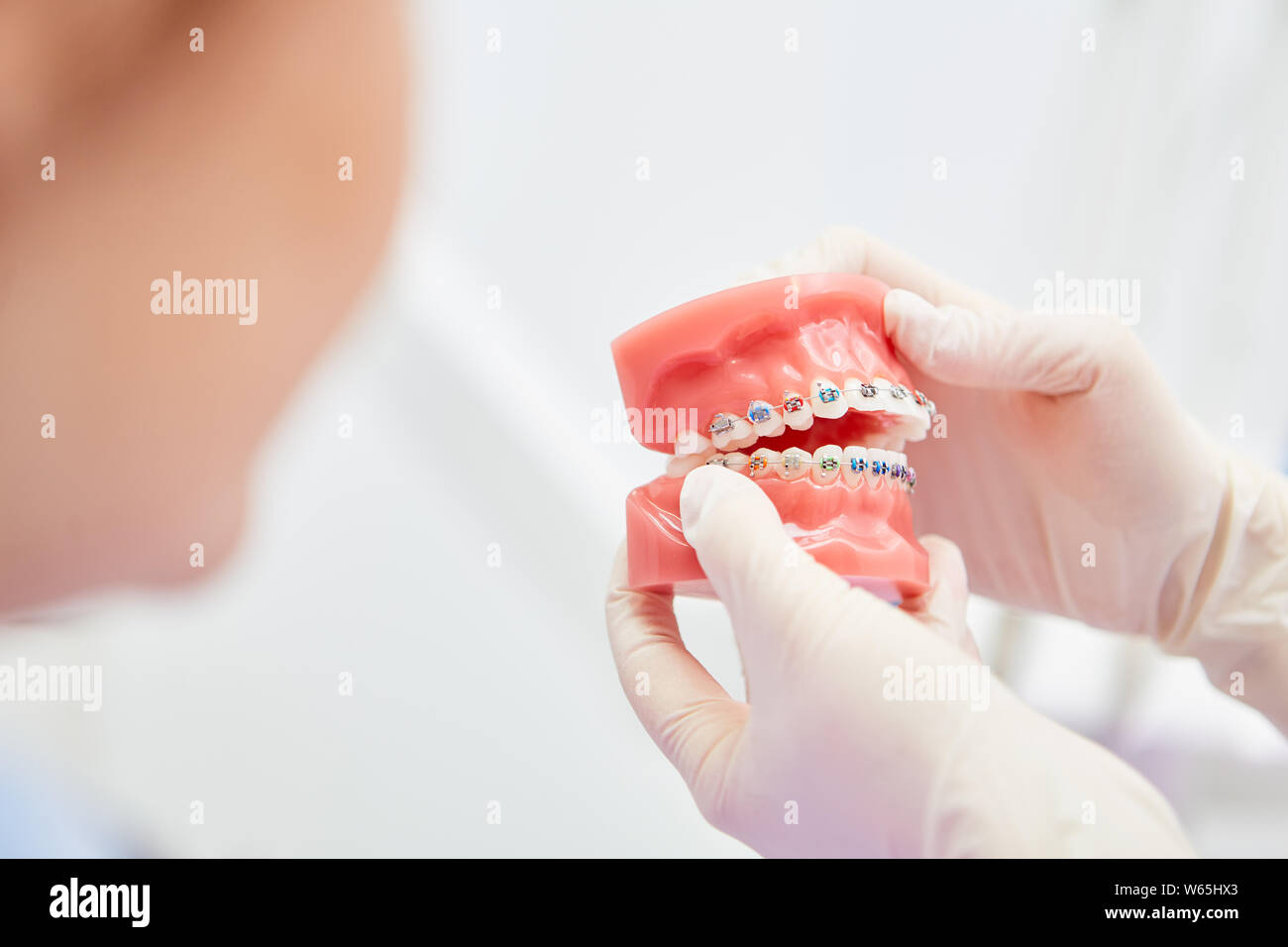 Gloves show a denture model with braces to correct a malocclusion Stock Photo