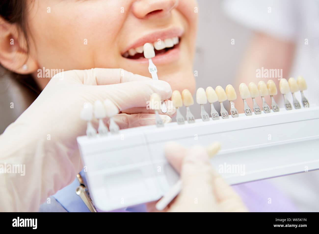 Selection of the correct tooth color for professional cosmetic bleaching at the dentist Stock