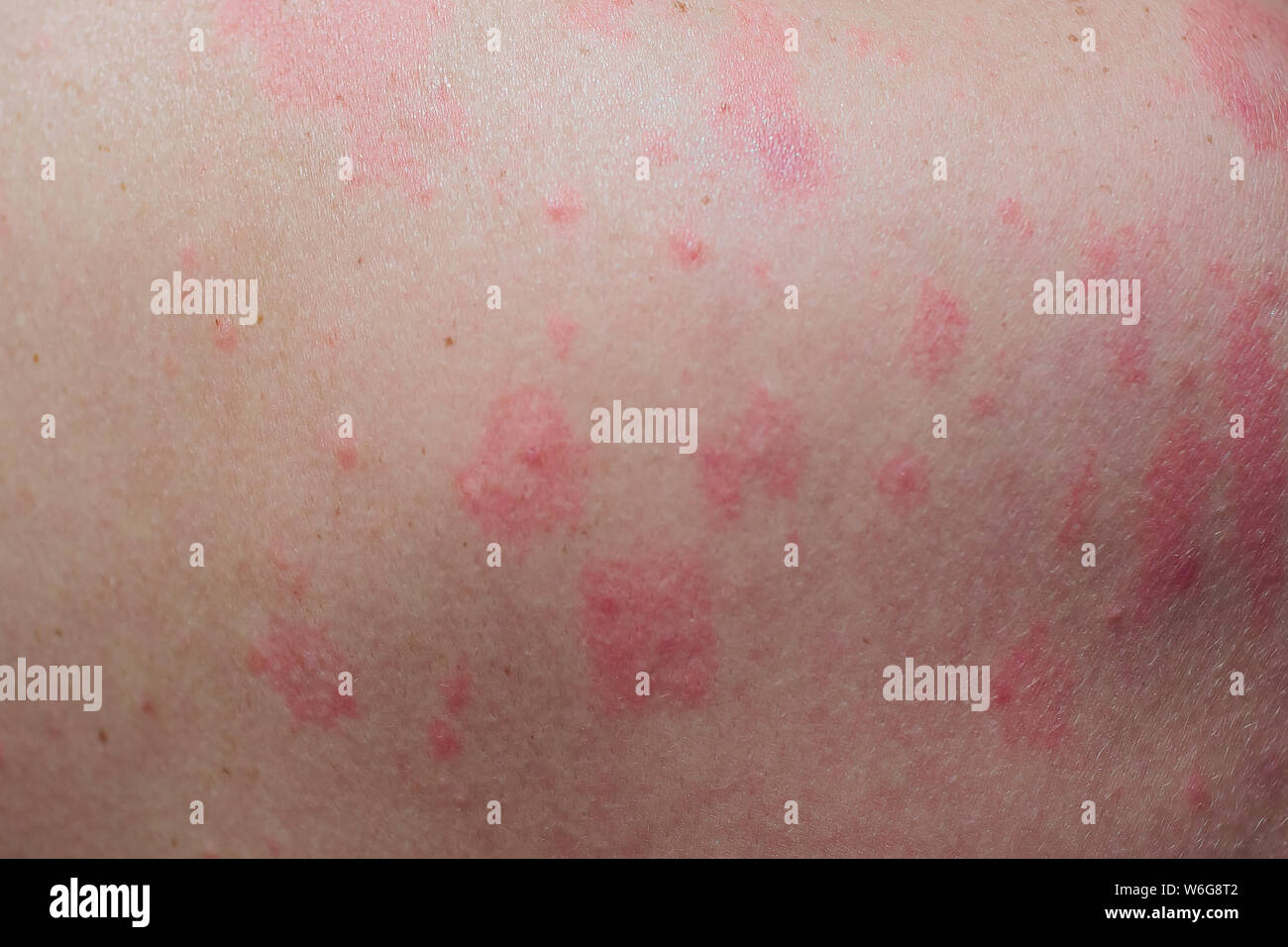 Close up Allergy rash, Around Back view of human with dermatitis